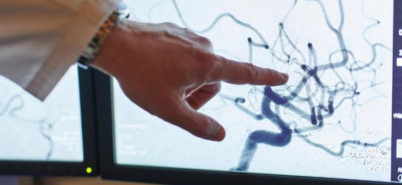 Arzt zeigt auf ein Aneurysma auf einem Bildschirm